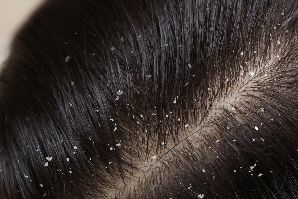 Image showing scalp with severe Dandruff.